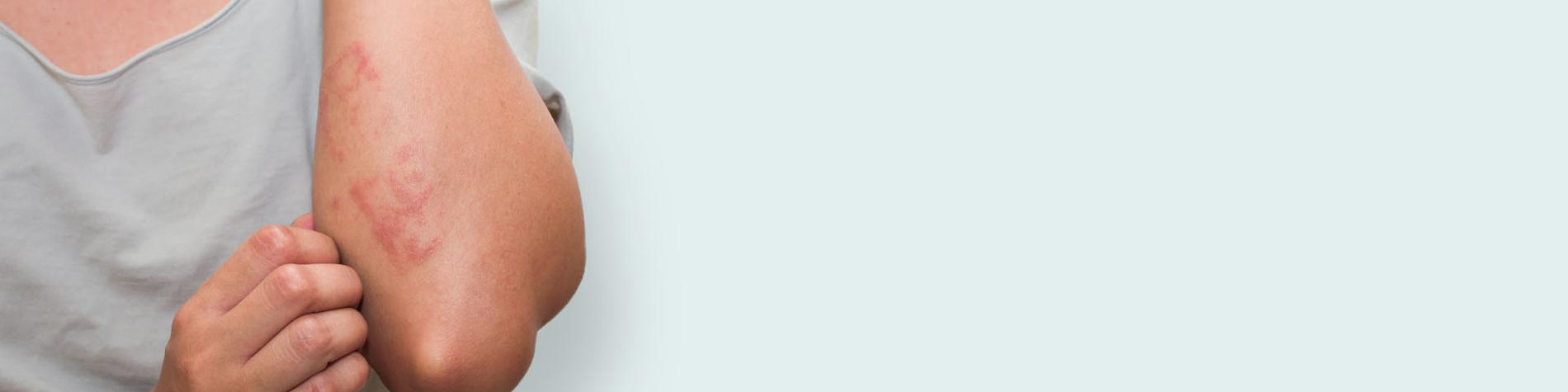 Eczema What is Eczema Symptoms Causes Diagnosis Treatment