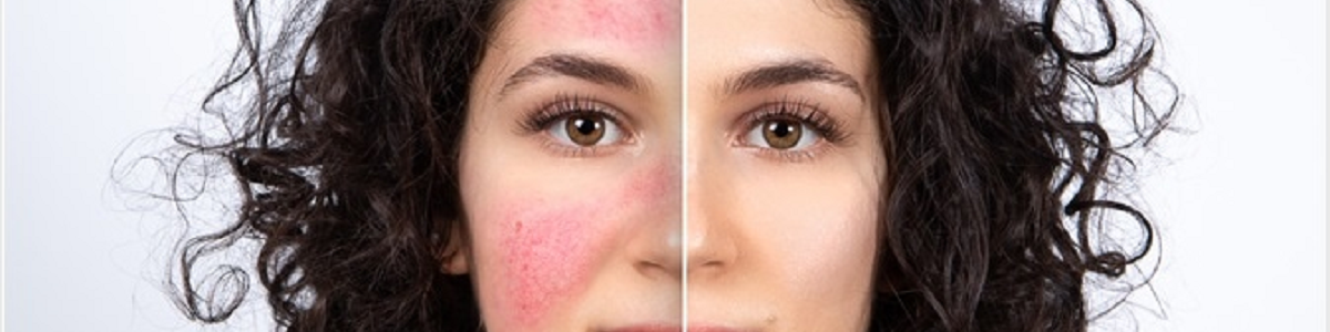 Rosacea - Causes Types Symptoms Diagnosis Treatment Medications Diet Lifestyle Management