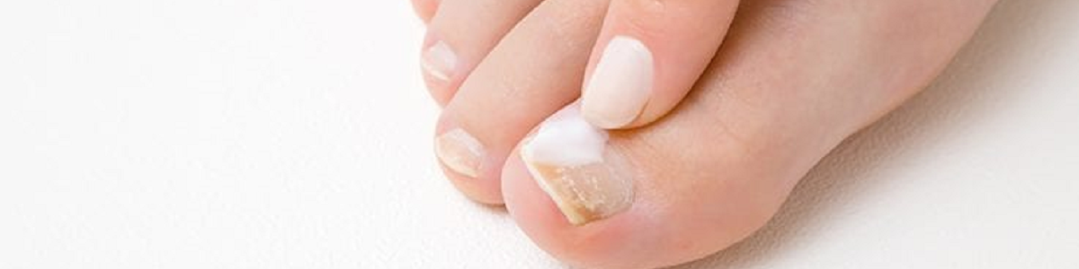 Nail Fungus - What is Nail Fungus Types Causes Symptoms Diagnosis Treatment