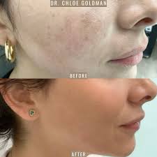 Hydroquinone Before and After: Realistic Results for Dark Spots and Melasma